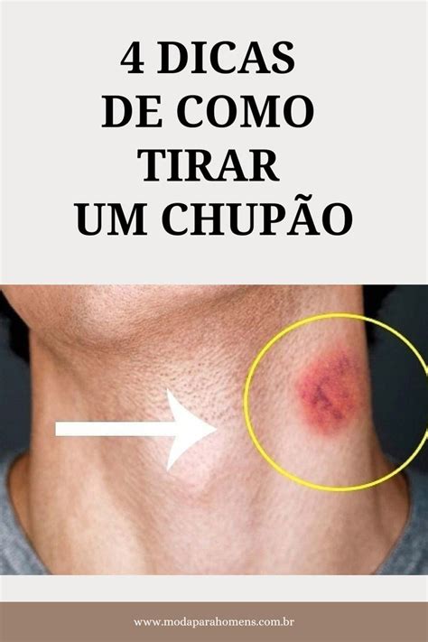 tirar chupada|Como tirar chupão do Pescoço